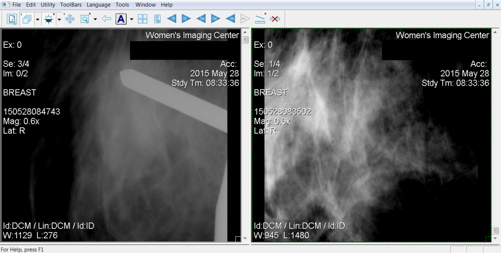 5-28-15 Biopsy location